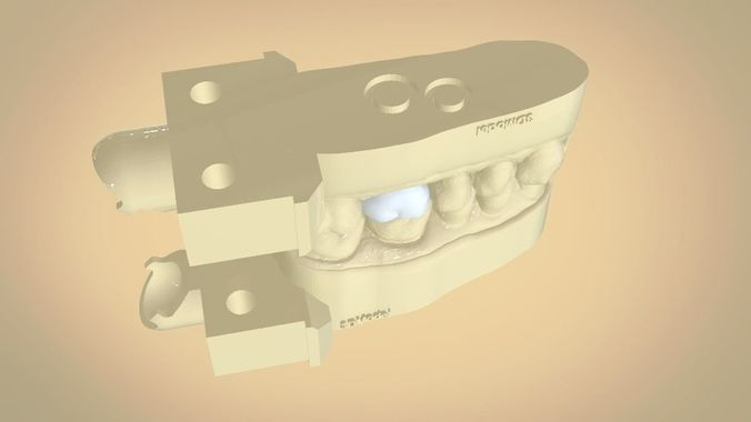 Digital Dental Quadrant  Model with a Full Contour Crown 3D print model