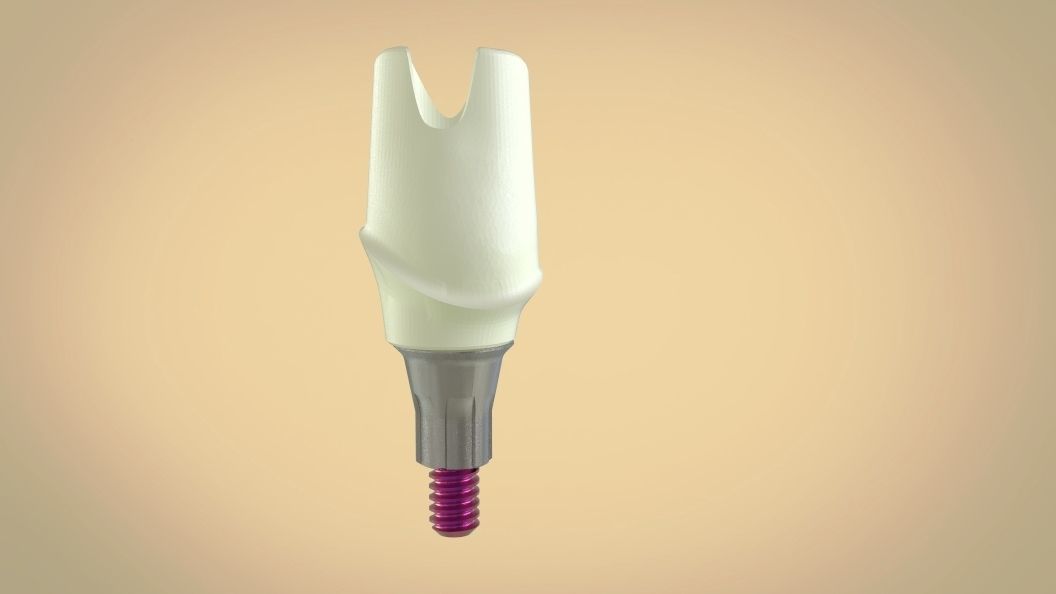 Digital Screw Retained Abutment 3D print model_3
