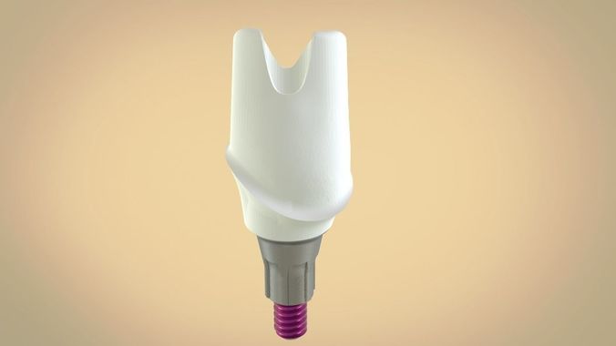 Digital Screw Retained Abutment 3D print model