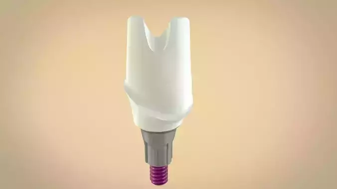Digital Screw Retained Abutment 3D print model