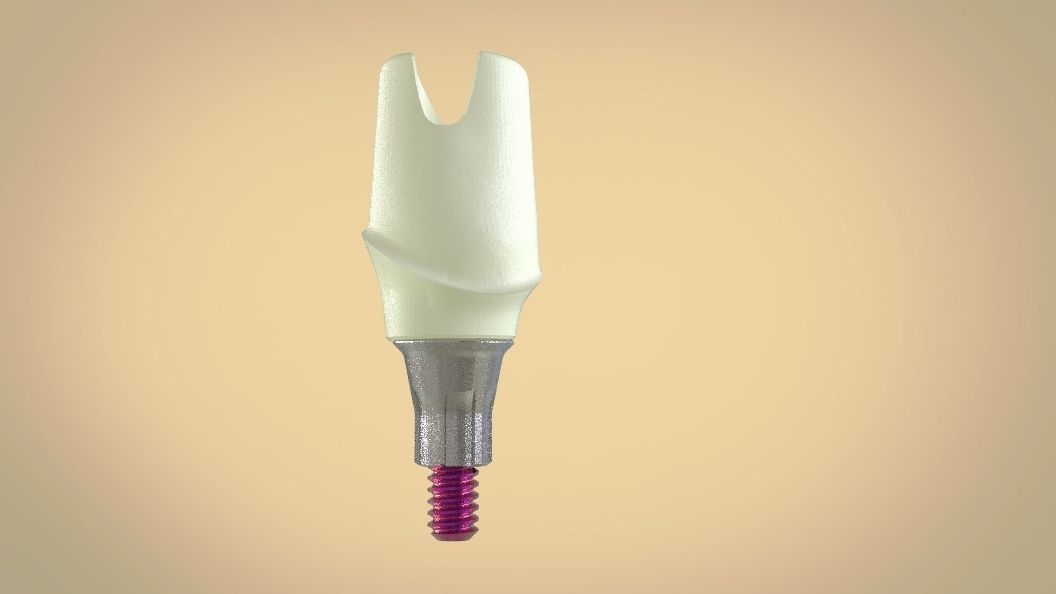 Digital Screw Retained Abutment 3D print model_5