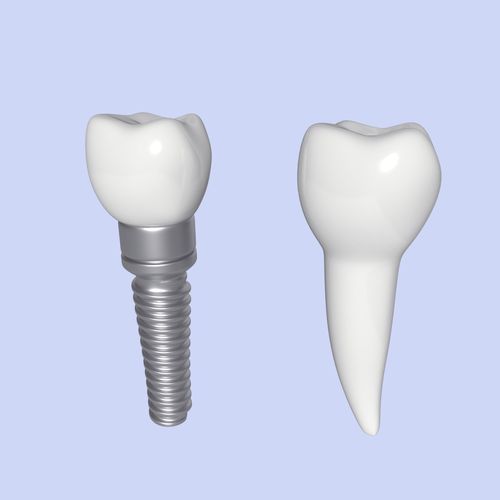Tooth Implant - premolar Low-poly 3D model