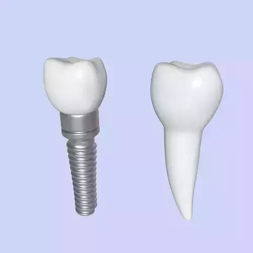 Tooth Implant - premolar Low-poly 3D model
