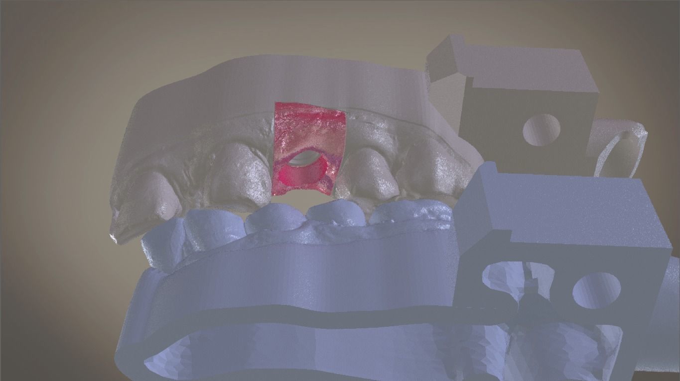 Digital Implant Model with Soft Tissue 3D print model_9