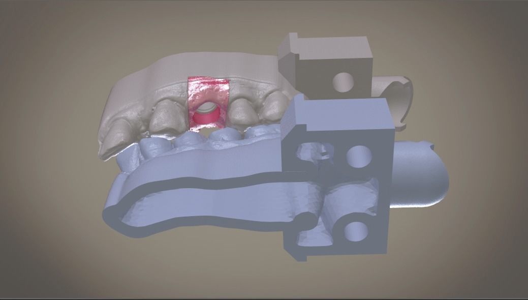 Digital Implant Model with Soft Tissue 3D print model_5
