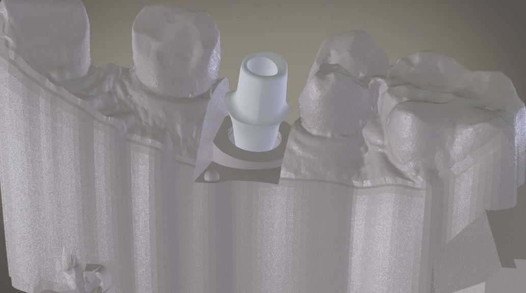 Digital Implant Model with Soft Tissue 3D print model_11
