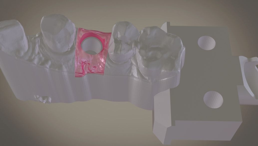 Digital Implant Model with Soft Tissue 3D print model_8