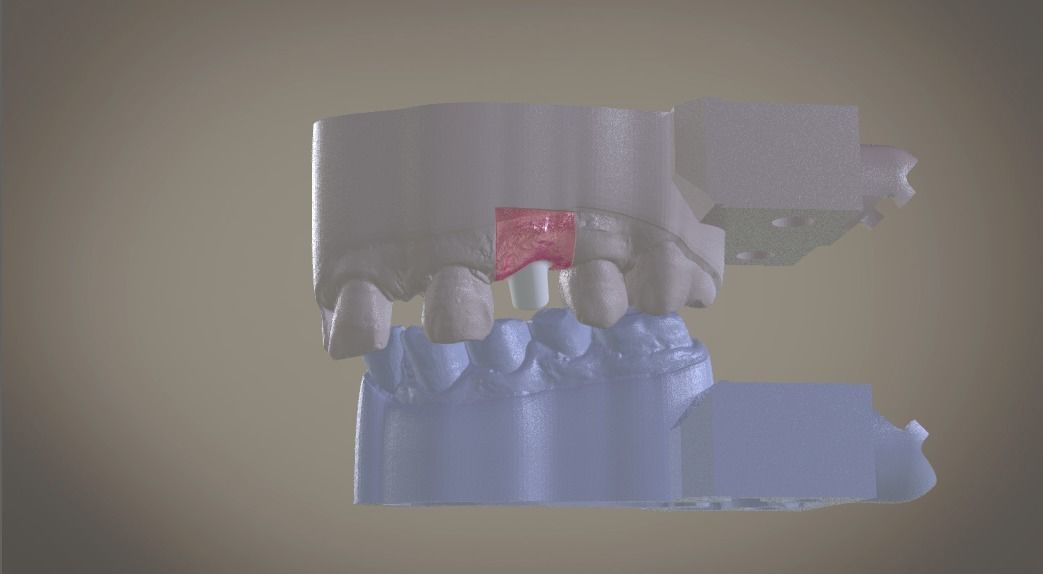 Digital Implant Model with Soft Tissue 3D print model_17