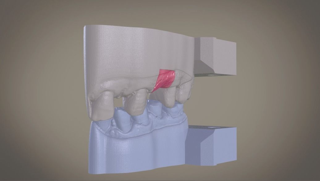 Digital Implant Model with Soft Tissue 3D print model_2