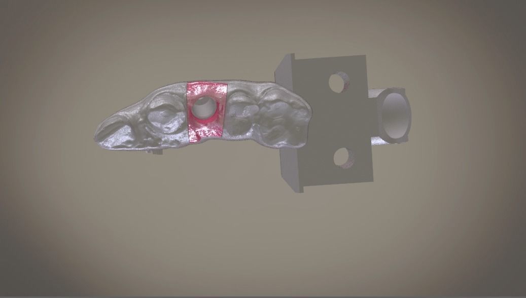 Digital Implant Model with Soft Tissue 3D print model_7