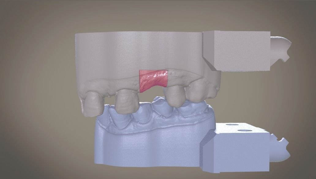 Digital Implant Model with Soft Tissue 3D print model_13