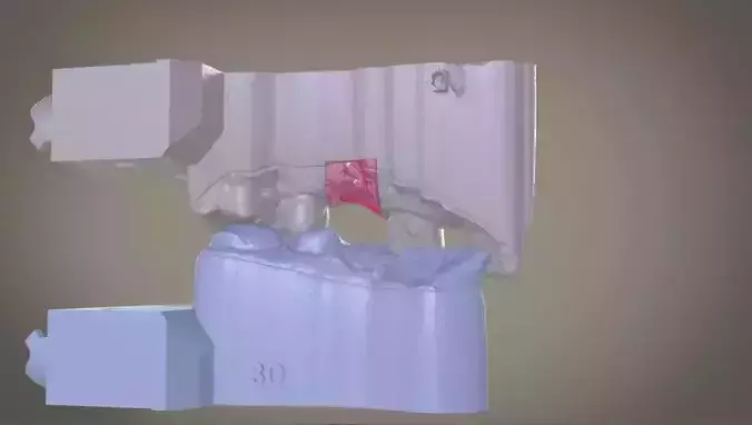 Digital Implant Model with Soft Tissue 3D print model