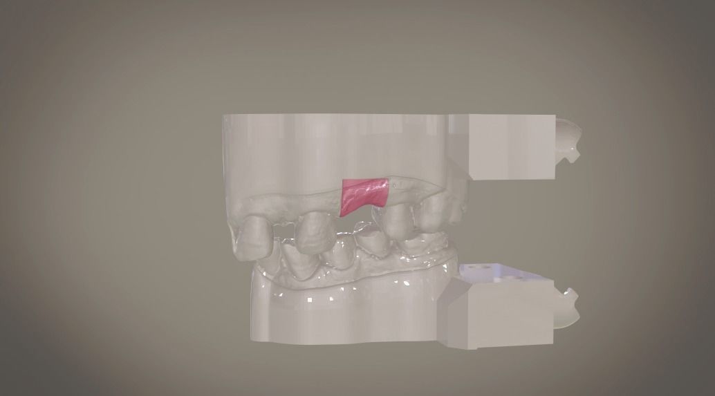 Digital Implant Model with Soft Tissue 3D print model_15