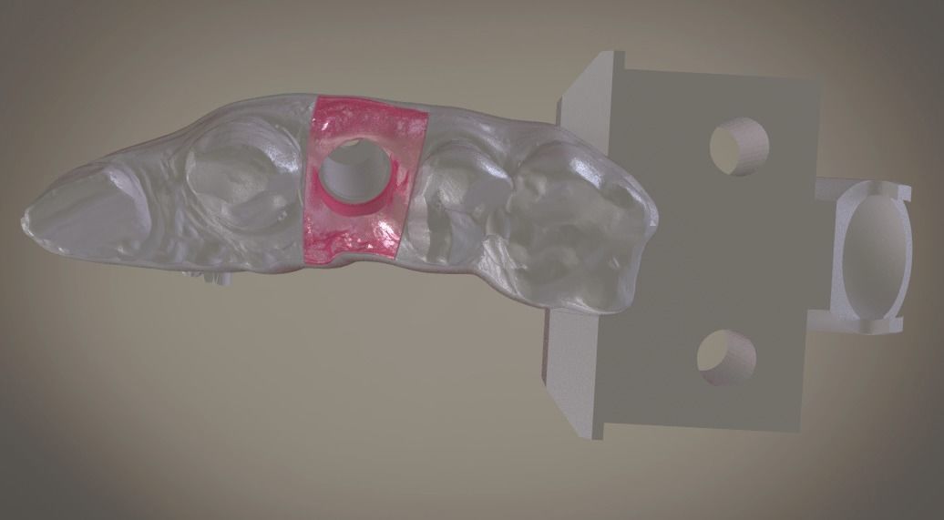 Digital Implant Model with Soft Tissue 3D print model_6