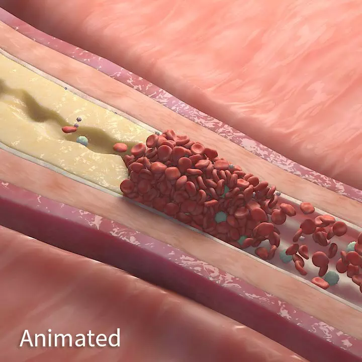 Fat Clot in Blood Stream Animation 3D model_0