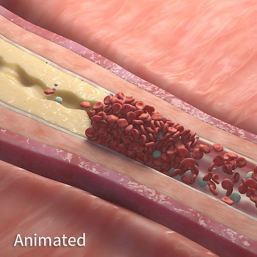 Fat Clot in Blood Stream Animation 3D model