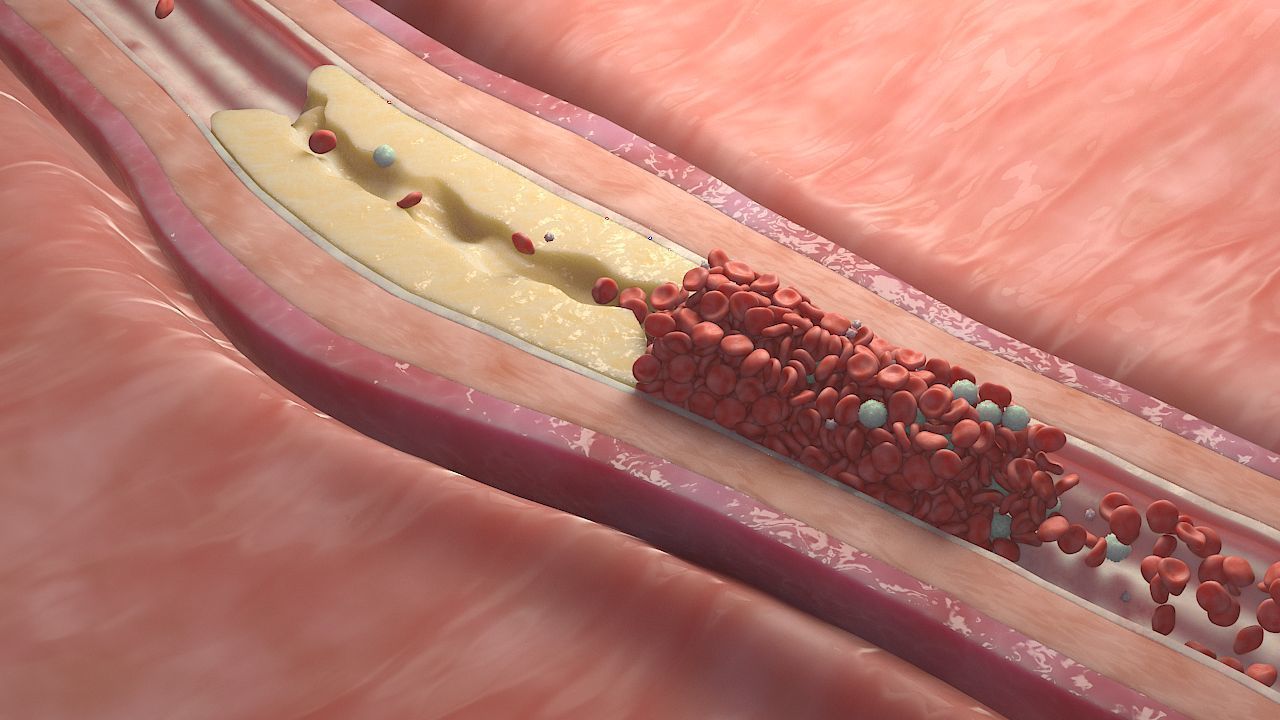 Fat Clot in Blood Stream Animation 3D model_7