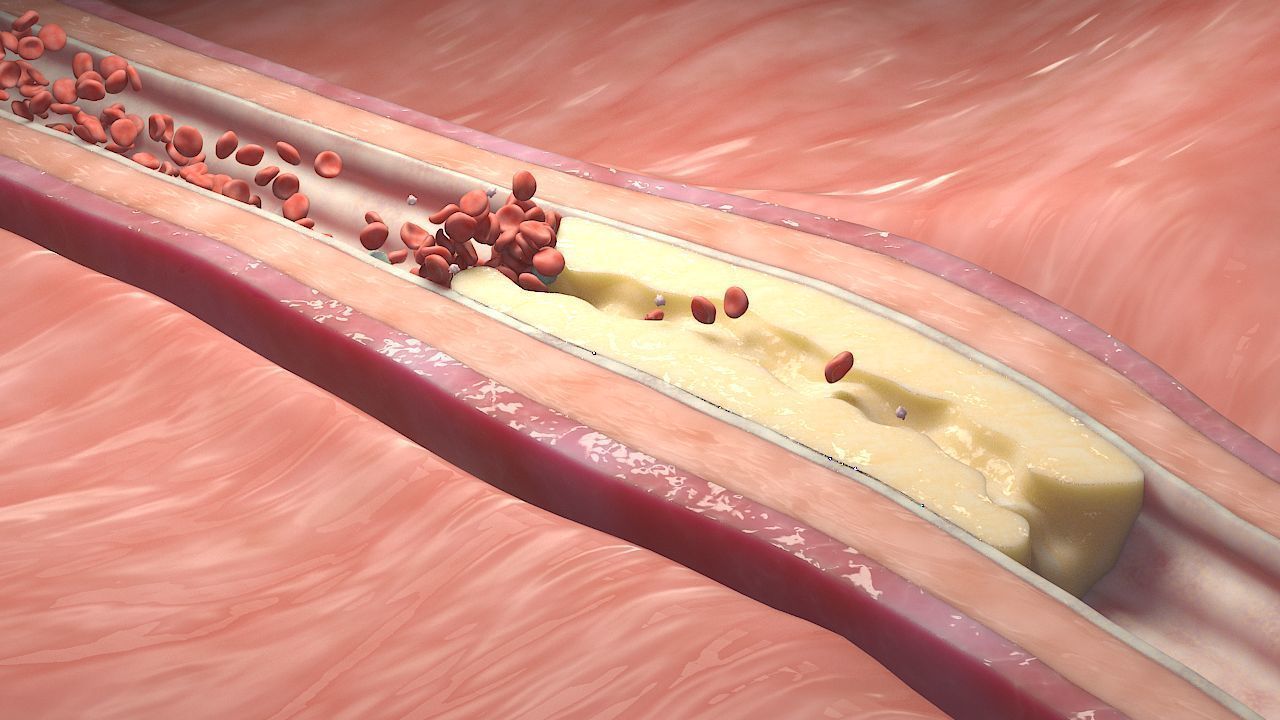 Fat Clot in Blood Stream Animation 3D model_5