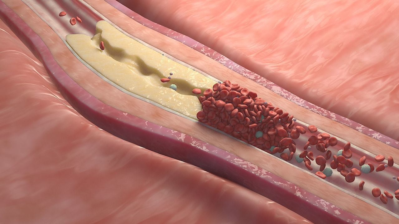 Fat Clot in Blood Stream Animation 3D model_4